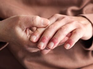Help for Eczema Strategies, Tips, and Resources for a Happy Skin