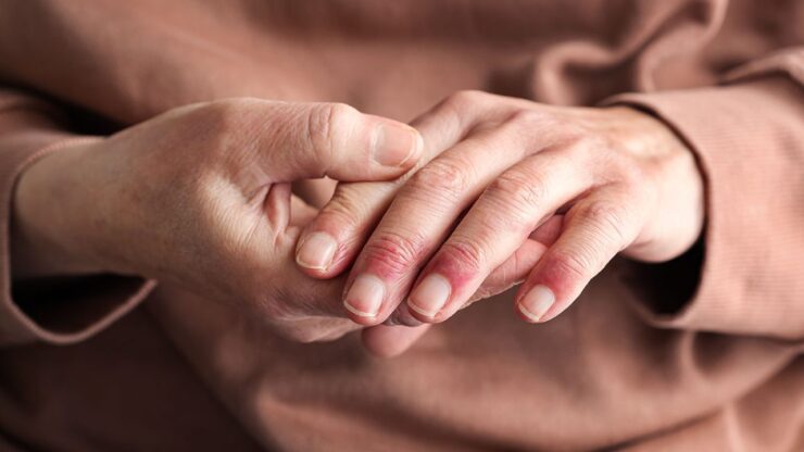 Help for Eczema Strategies, Tips, and Resources for a Happy Skin